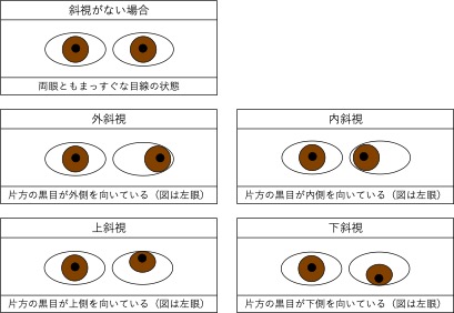 内斜視、外斜視、上下斜視など眼位のずれる方向を示した図